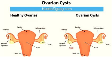 twisted or ruptured ovarian cyst